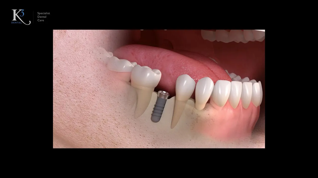 A frame of Straumann’s animation: an implant in a model of the lower jaw, framed on black with the small K3 logo